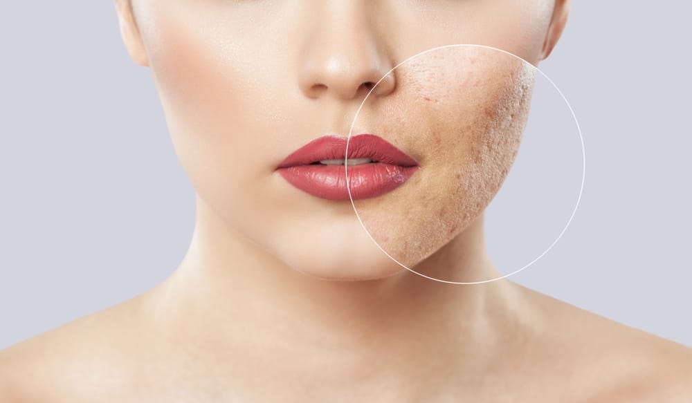 chemical peel woman model
